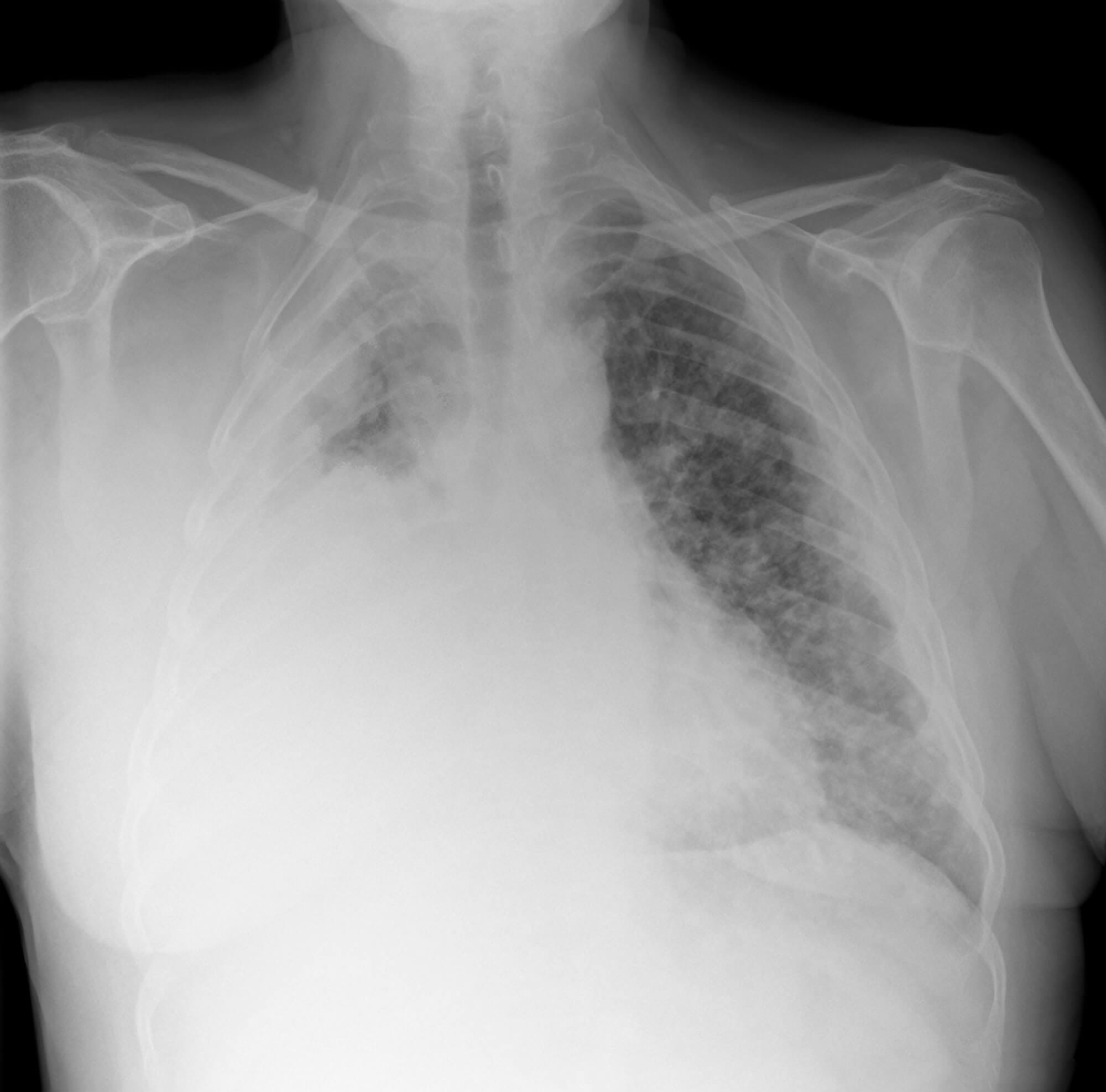 Mesothelioma Client Asbestos Disease Case Thompsons Trade Union Solicitors