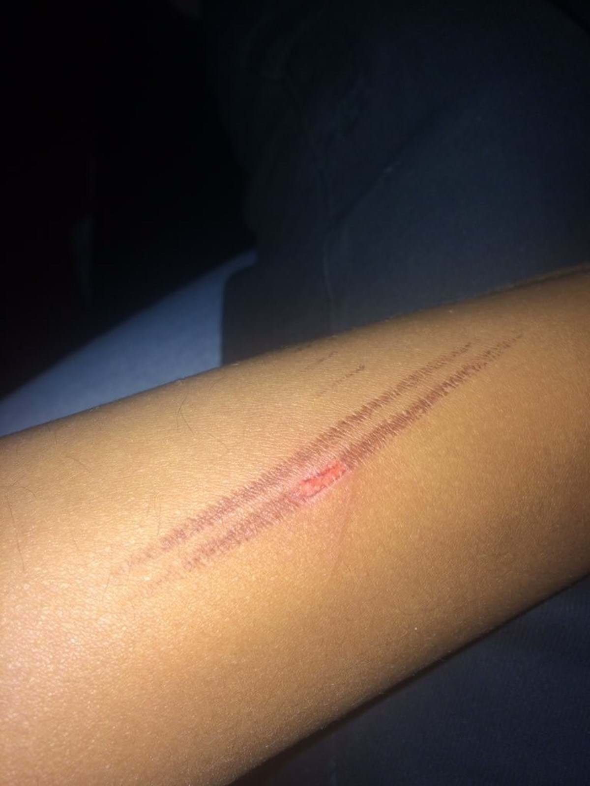 Burn injury suffered by BFAWU member whilst working for McDonald’s